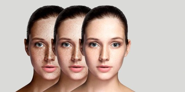 pigmentation removal treatment in Lucknow